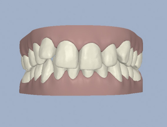 invisalign-masinfo1