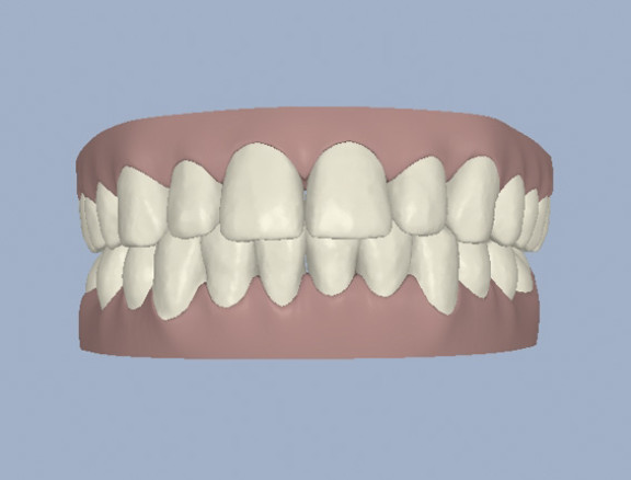 invisalign-masinfo2